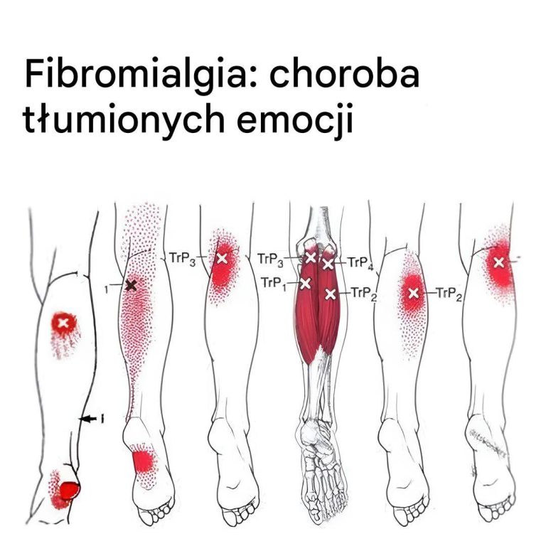 Jaki jest związek pomiędzy fibromialgią a emocjami?