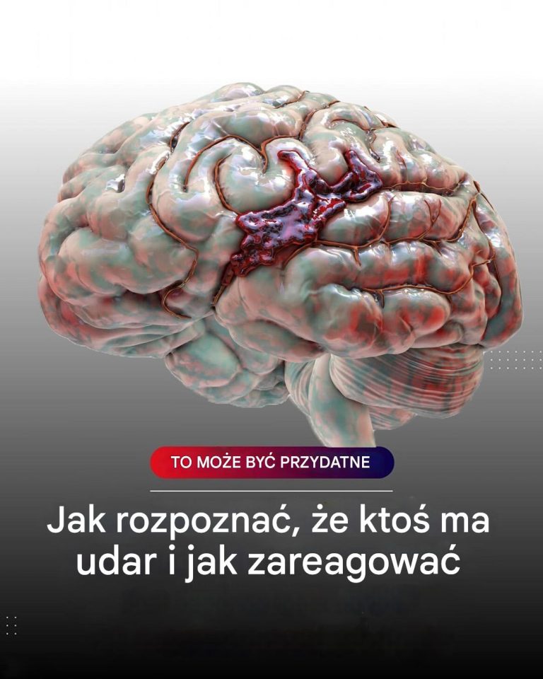 Udar mózgu często ma oczywiste objawy, ale w rzeczywistości wiele osób je ignoruje lub myli z mniej poważnymi schorzeniami.