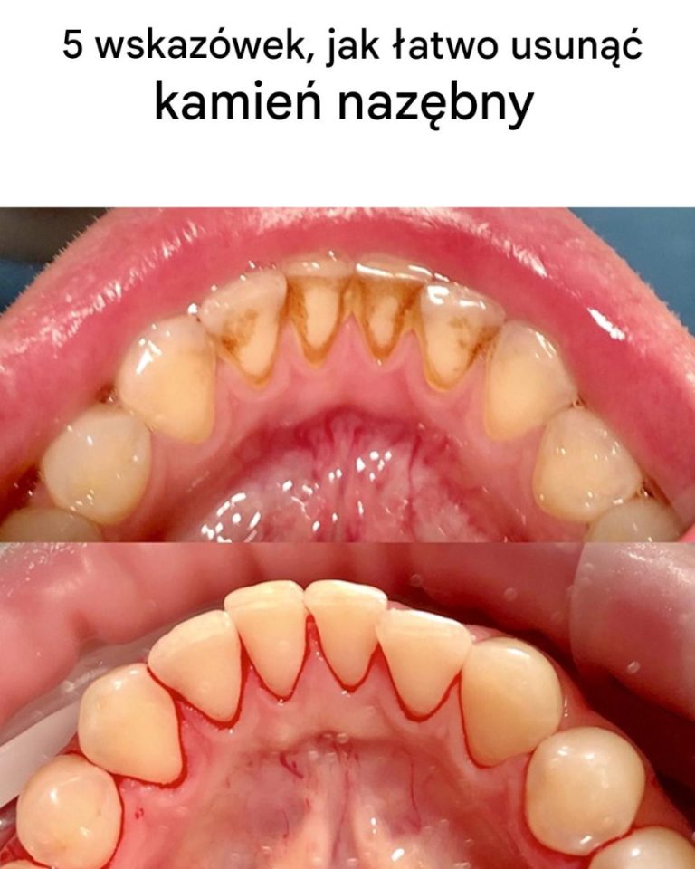 5 wskazówek, jak usunąć kamień nazębny